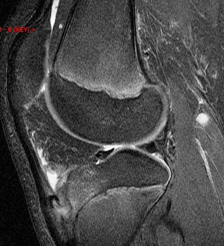 Figure 6 for case avulsion fracture MFC and tibial tubercle fx ( RID2896 ) ( RID4653 )